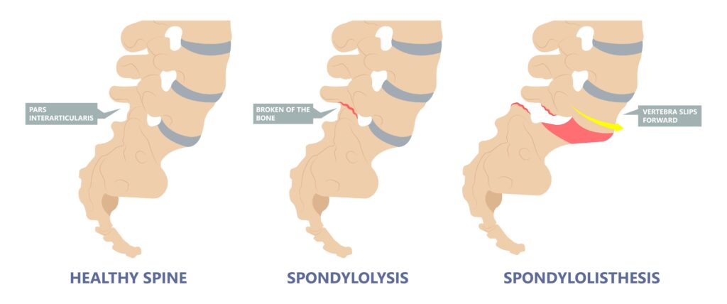 Spondylolysis vs. Spondylolisthesis graphic