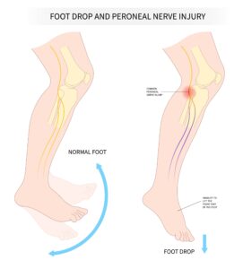 Illustration of foot drop condition