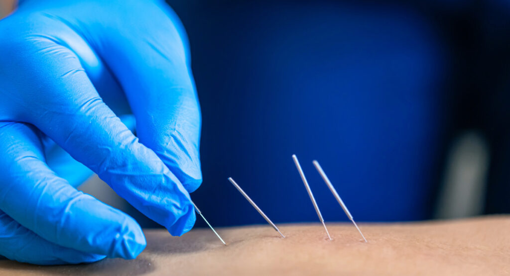 Acupuncture needles being inserted