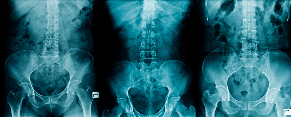 What is Degenerative Disc Disease? - RAI